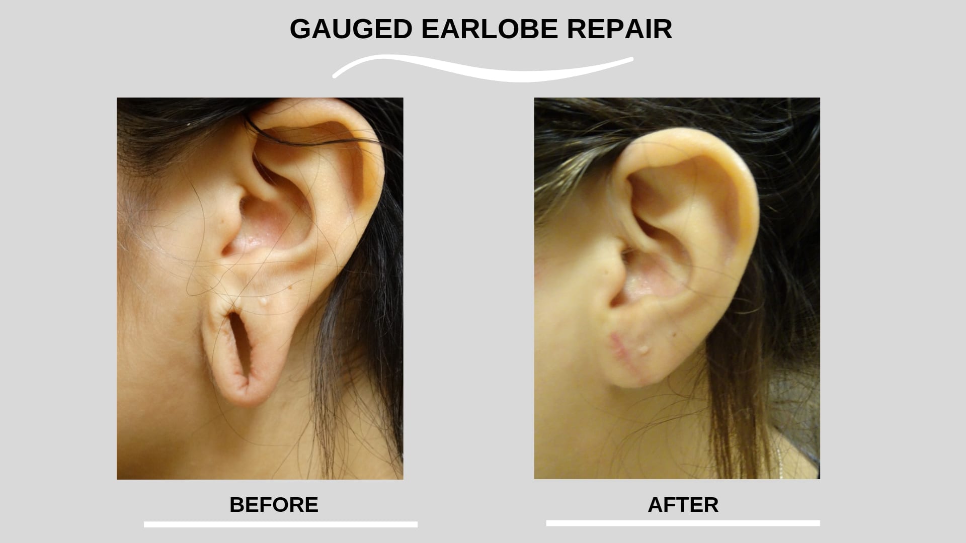 Repair Gauged Earlobes With Ear Surgery - Blogs by Ronald M